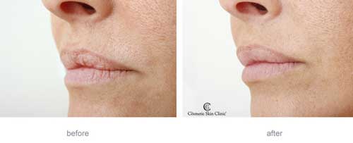 Before and After Restylane Lip treatment